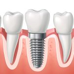 How Dental Implants Support Athletic Performance Through Enhanced Bite Stability