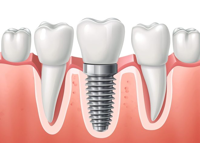 How Dental Implants Support Athletic Performance Through Enhanced Bite Stability