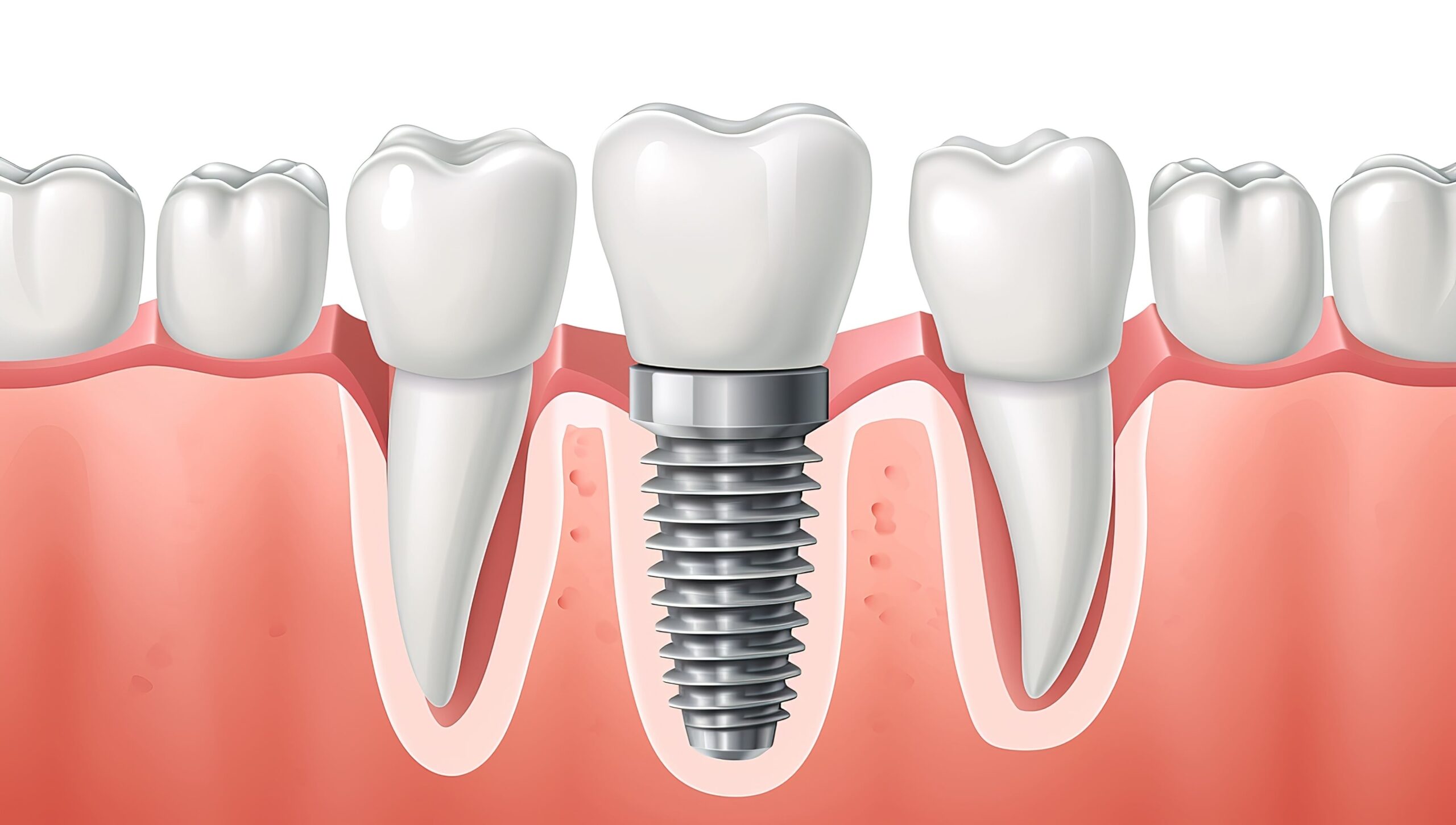 How Dental Implants Support Athletic Performance Through Enhanced Bite Stability