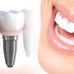 How Dental Implants Reduce the Risk of Gum Disease and Promote Long-Term Periodontal Health