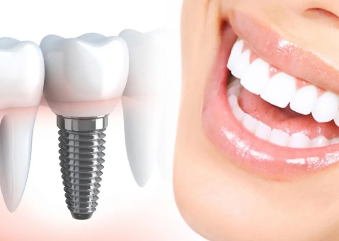 How Dental Implants Reduce the Risk of Gum Disease and Promote Long-Term Periodontal Health