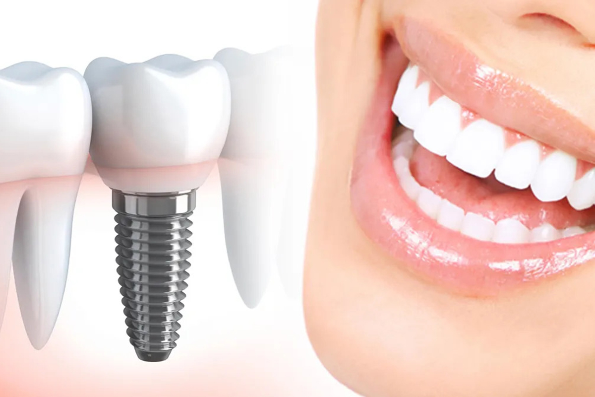 How Dental Implants Reduce the Risk of Gum Disease and Promote Long-Term Periodontal Health